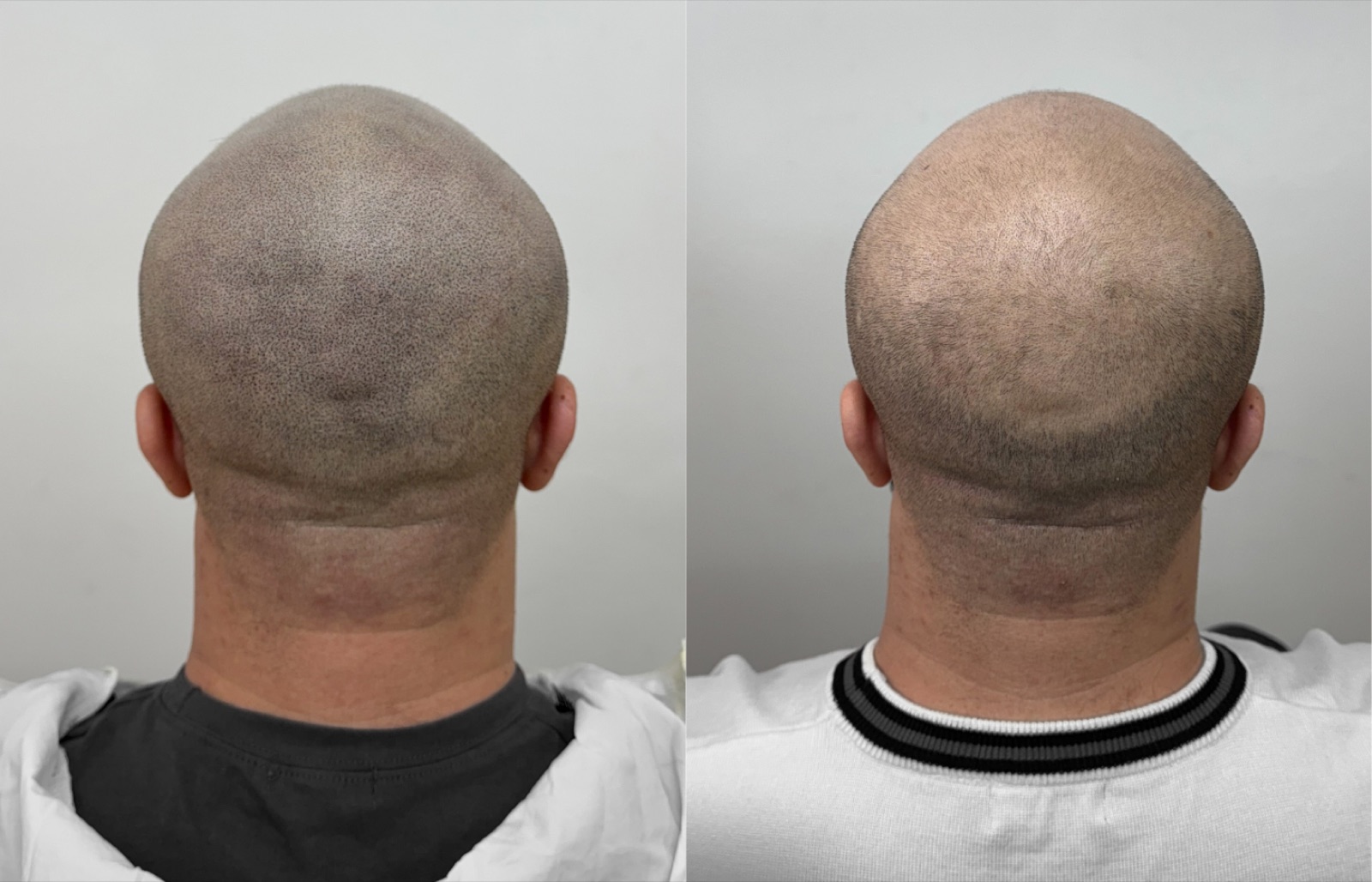 Shaved look SMP portfolio 31